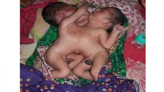 নরসিংদীতে পেট-বুক জোড়া লাগানো যমজ শিশুর জন্ম