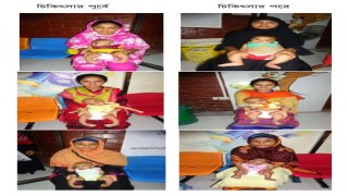 শিশুদের জন্মগত ক্রটি ক্লাব ফুট ও তার আধুনিক চিকিৎসা