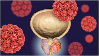 এআই শনাক্ত করবে প্রোস্টেট ক্যানসার