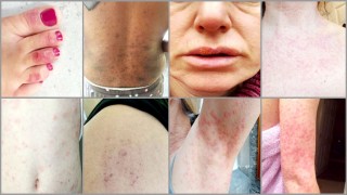 ত্বকে যে ৮ ধরনের র্যাশ কোভিড-১৯ রোগের উপসর্গ হতে পারে... ত্বকে যে ৮ ধরনের র্যাশ কোভিড-১৯ রোগের উপসর্গ হতে পারে...